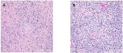 Kikuchi-Fujimoto Disease With Encephalopathy in Children: Case Reports and Literature Review